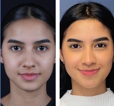 Rinoplastia caso 2 — antes y después